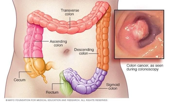 Illustation of the anatomy of the colon as well as what colon cancer looks like in the body