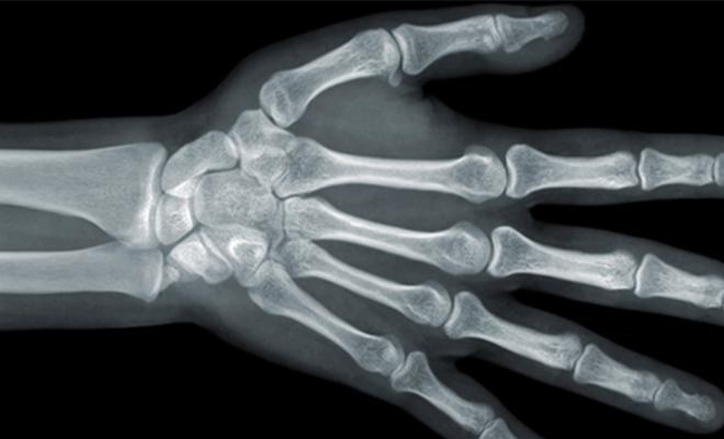 This is an x-ray image of a hand.